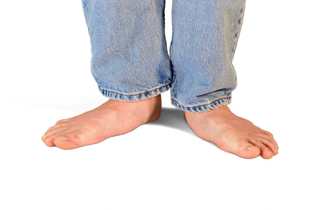 Everything You Need To Know About Flat Feet Iphysio Blog